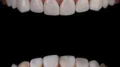 Chi sceglie le faccette dentali conquista sicurezza e un sorriso che illumina